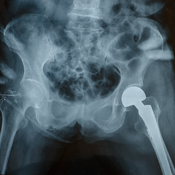 load bearing activities new cells treatment x rays iliac crest injected directly platelet rich plasma hip arthroscopy