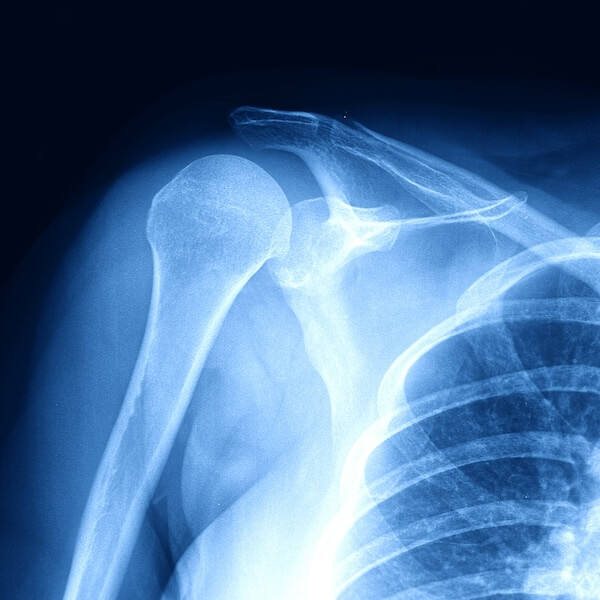 stem cell therapy for shoulder pain